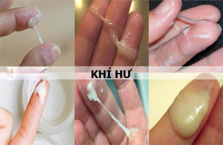 vi&ecirc;m &acirc;m đạo , vi&ecirc;m nấm phụ khoa